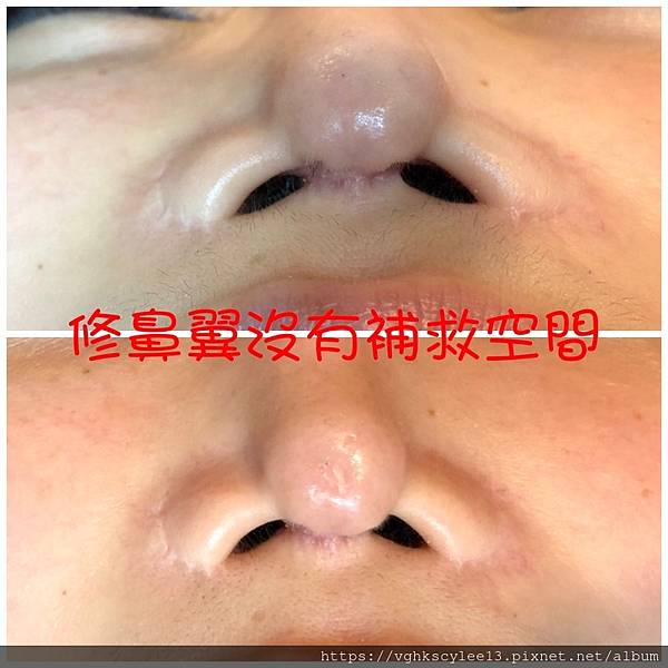 隆鼻價位多少?為什麼差異大!原因? 隆鼻價位多少?為什麼差異大!原因?