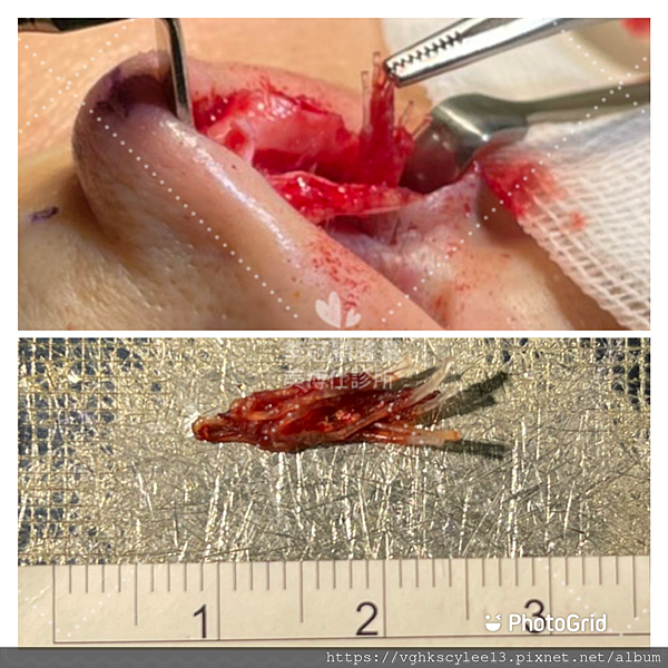 『鼻雕』還是『鼻凋』?到底鼻子埋線有什麼風險必須知道?你的埋 『鼻雕』還是『鼻凋』?到底鼻子埋線有什麼風險必須知道?你的埋