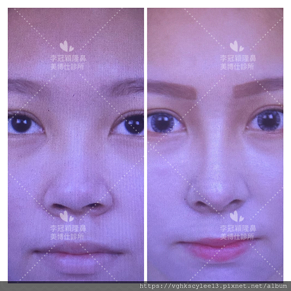 『鼻雕』還是『鼻凋』?到底鼻子埋線有什麼風險必須知道?你的埋 『鼻雕』還是『鼻凋』?到底鼻子埋線有什麼風險必須知道?你的埋