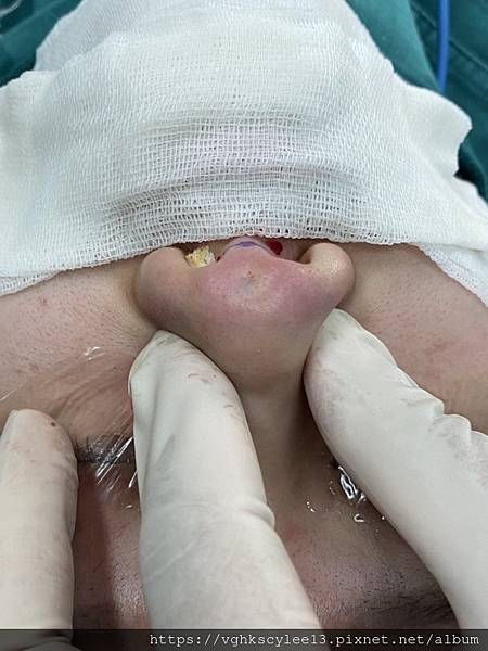 『鼻雕』還是『鼻凋』?到底鼻子埋線有什麼風險必須知道?你的埋 『鼻雕』還是『鼻凋』?到底鼻子埋線有什麼風險必須知道?你的埋