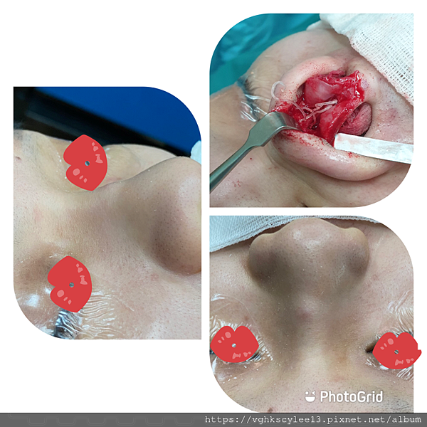 『鼻雕』還是『鼻凋』?到底鼻子埋線有什麼風險必須知道?你的埋 『鼻雕』還是『鼻凋』?到底鼻子埋線有什麼風險必須知道?你的埋