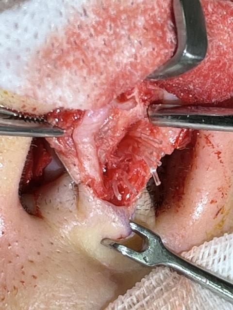 『鼻雕』還是『鼻凋』?到底鼻子埋線有什麼風險必須知道?你的埋 『鼻雕』還是『鼻凋』?到底鼻子埋線有什麼風險必須知道?你的埋