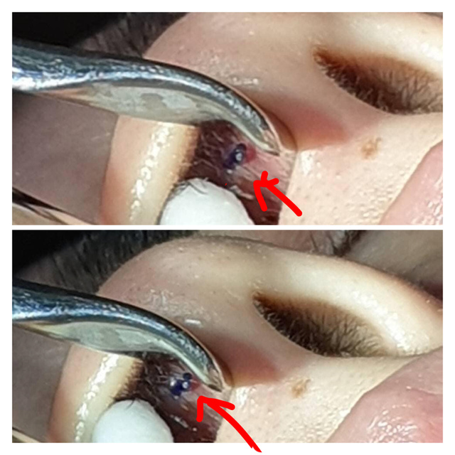 『鼻雕』還是『鼻凋』?到底鼻子埋線有什麼風險必須知道?你的埋 『鼻雕』還是『鼻凋』?到底鼻子埋線有什麼風險必須知道?你的埋