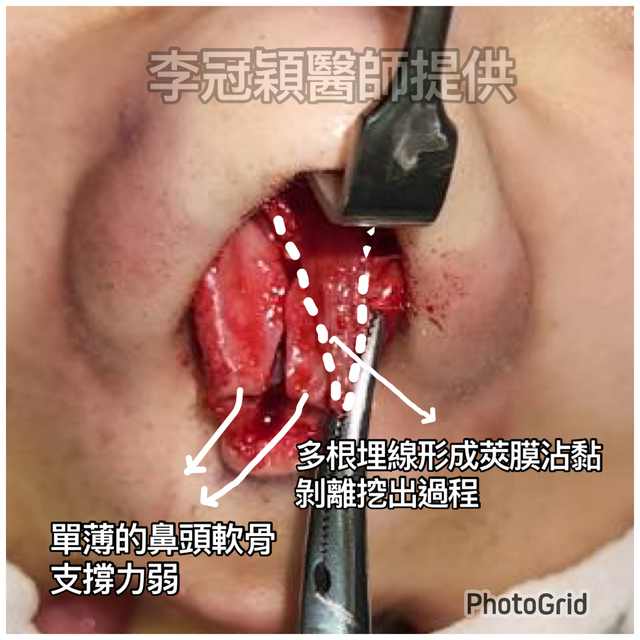 『鼻雕』還是『鼻凋』?到底鼻子埋線有什麼風險必須知道?你的埋 『鼻雕』還是『鼻凋』?到底鼻子埋線有什麼風險必須知道?你的埋