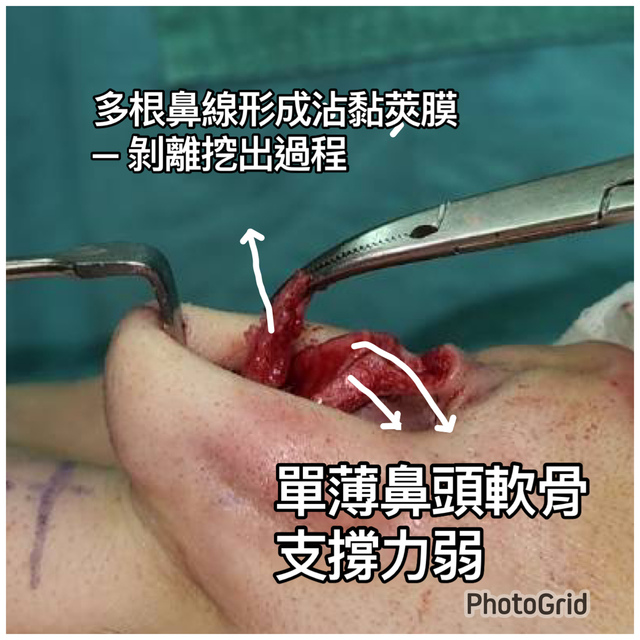 『鼻雕』還是『鼻凋』?到底鼻子埋線有什麼風險必須知道?你的埋 『鼻雕』還是『鼻凋』?到底鼻子埋線有什麼風險必須知道?你的埋