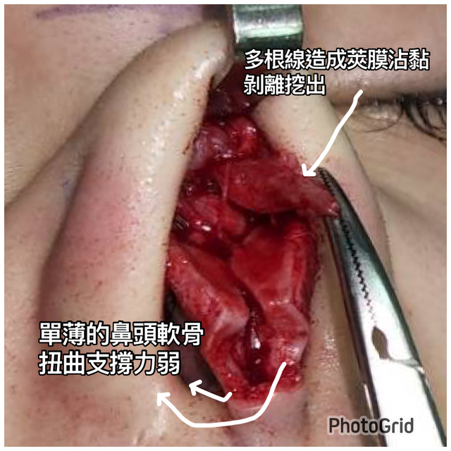 『鼻雕』還是『鼻凋』?到底鼻子埋線有什麼風險必須知道?你的埋 『鼻雕』還是『鼻凋』?到底鼻子埋線有什麼風險必須知道?你的埋