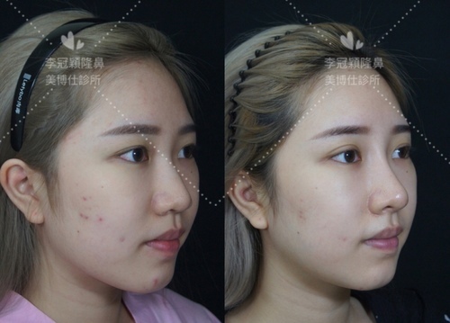 『鼻雕』還是『鼻凋』?到底鼻子埋線有什麼風險必須知道?你的埋 『鼻雕』還是『鼻凋』?到底鼻子埋線有什麼風險必須知道?你的埋