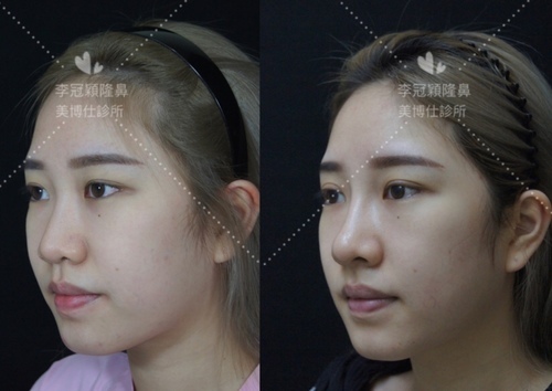 『鼻雕』還是『鼻凋』?到底鼻子埋線有什麼風險必須知道?你的埋 『鼻雕』還是『鼻凋』?到底鼻子埋線有什麼風險必須知道?你的埋