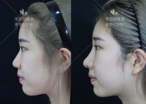 『鼻雕』還是『鼻凋』?到底鼻子埋線有什麼風險必須知道?你的埋 『鼻雕』還是『鼻凋』?到底鼻子埋線有什麼風險必須知道?你的埋