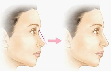 隆鼻價位多少?為什麼差異大!原因? 隆鼻價位多少?為什麼差異大!原因?