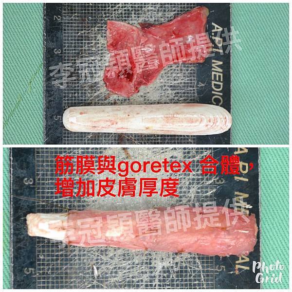 隆鼻價位多少?為什麼差異大!原因? 隆鼻價位多少?為什麼差異大!原因?