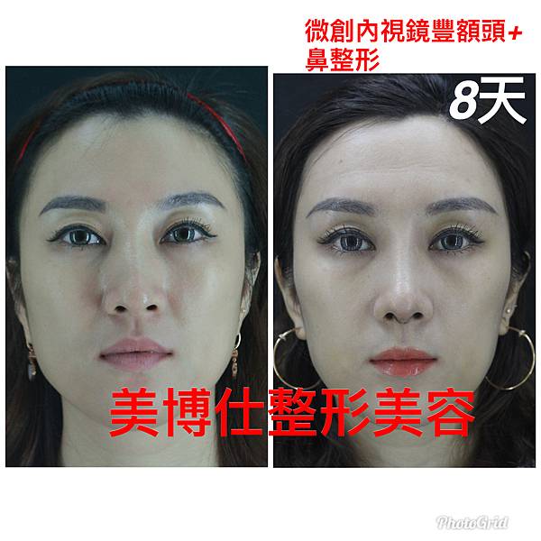 隆鼻價位多少?為什麼差異大!原因? 隆鼻價位多少?為什麼差異大!原因?