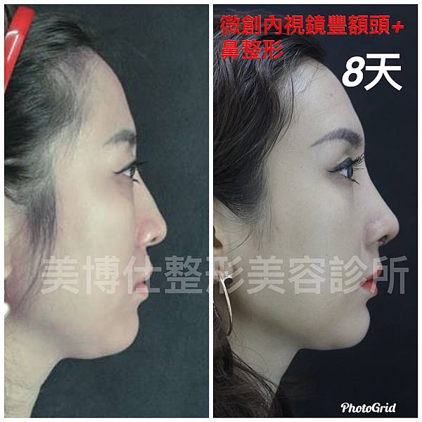 隆鼻價位多少?為什麼差異大!原因? 隆鼻價位多少?為什麼差異大!原因?