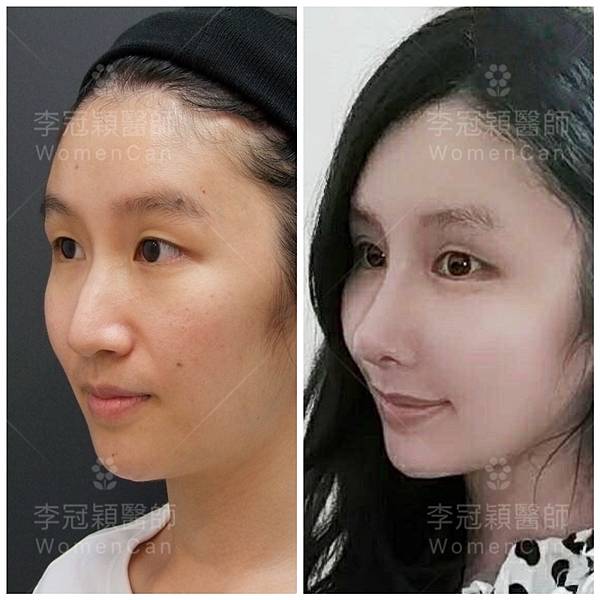 隆鼻價位多少?為什麼差異大!原因? 隆鼻價位多少?為什麼差異大!原因?