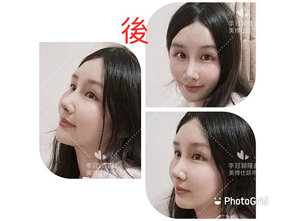 隆鼻價位多少?為什麼差異大!原因? 隆鼻價位多少?為什麼差異大!原因?