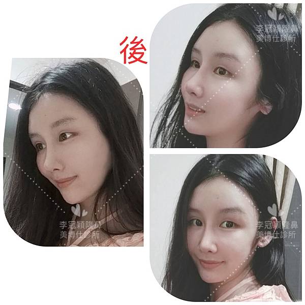 隆鼻價位多少?為什麼差異大!原因? 隆鼻價位多少?為什麼差異大!原因?