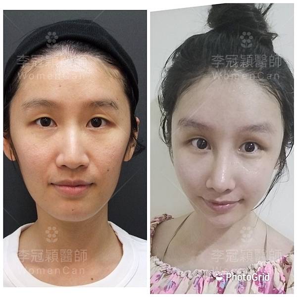 隆鼻價位多少?為什麼差異大!原因? 隆鼻價位多少?為什麼差異大!原因?