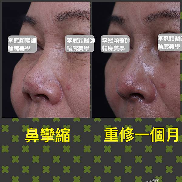 隆鼻價位多少?為什麼差異大!原因? 隆鼻價位多少?為什麼差異大!原因?