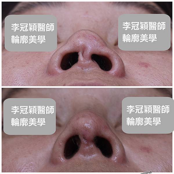 隆鼻價位多少?為什麼差異大!原因? 隆鼻價位多少?為什麼差異大!原因?