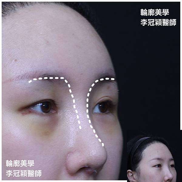 妳的國產臉條件能做Y型鼻（Y字眉心）嗎？和y鼻根有何不同？A