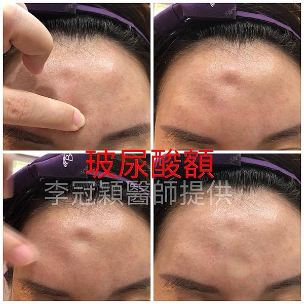 如何修正注射填充額頭的問題（饅化、凹凸、沾黏、壓眼、皮肉分離）？