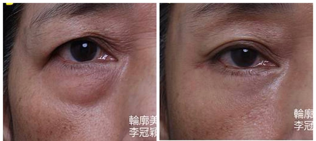 眼袋手術全解析：外開與內開的比較