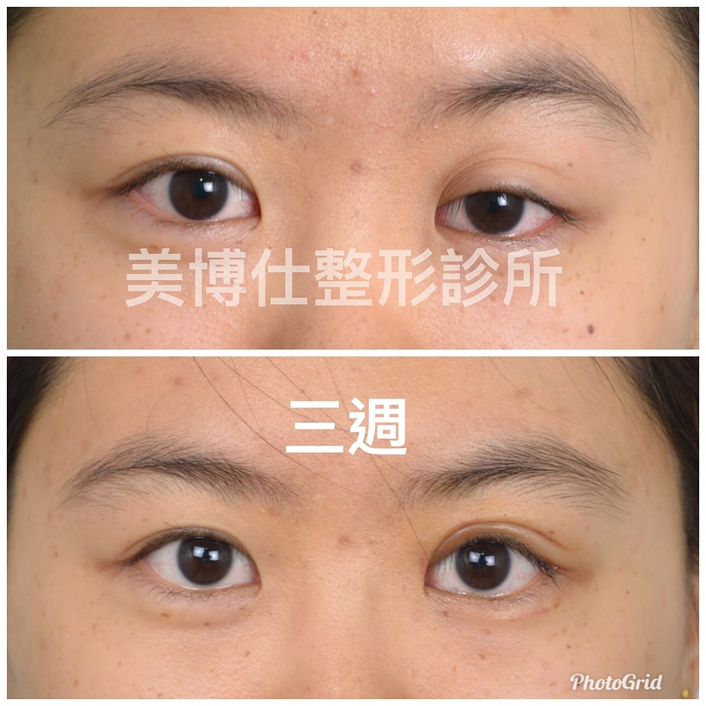 提眼肌無力矯正 提眼肌無力矯正