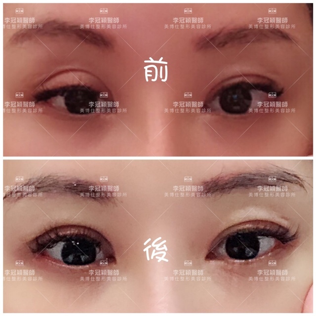 提眼肌無力矯正 IMG_0180.JPG - 眼鼻眼頭