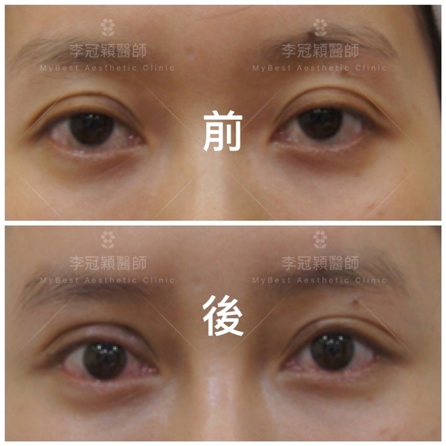 提眼肌無力矯正 提眼肌無力矯正