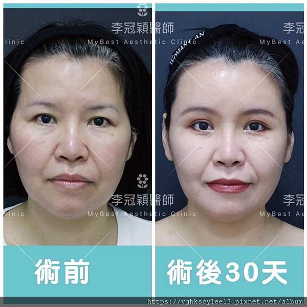 凹缺太陽穴和眉骨（眉弓）為什麼容易提早有下垂眼尾？如何治療？