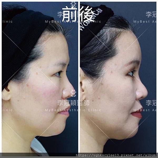 凹缺太陽穴和眉骨（眉弓）為什麼容易提早有下垂眼尾？如何治療？