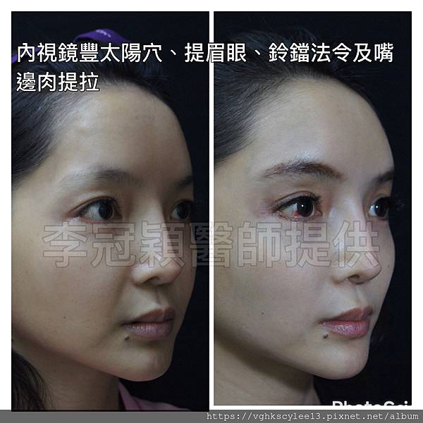 凹缺太陽穴和眉骨（眉弓）為什麼容易提早有下垂眼尾？如何治療？