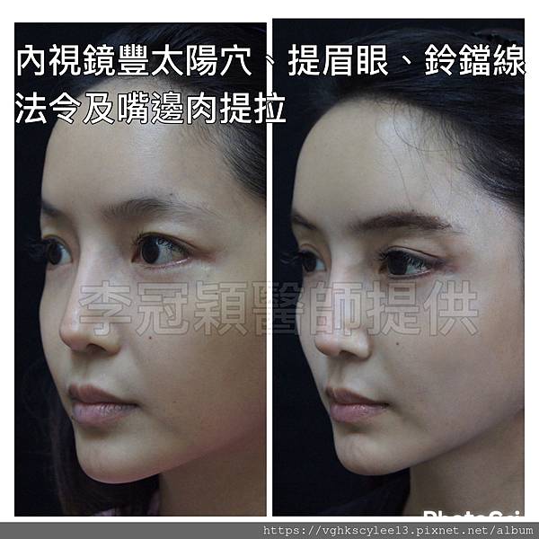 凹缺太陽穴和眉骨（眉弓）為什麼容易提早有下垂眼尾？如何治療？