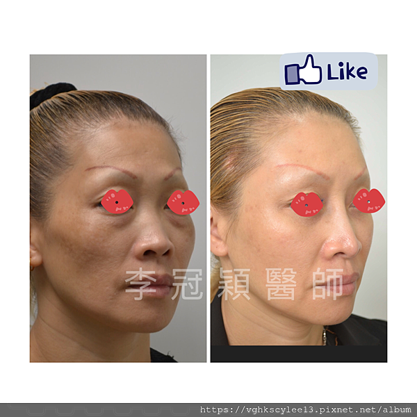 凹缺太陽穴和眉骨（眉弓）為什麼容易提早有下垂眼尾？如何治療？