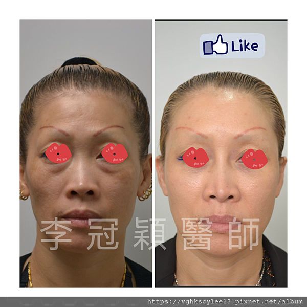 凹缺太陽穴和眉骨（眉弓）為什麼容易提早有下垂眼尾？如何治療？