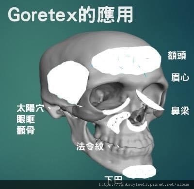 什麼是Goretex ( e- PTFE )? 在整形的運用有那些？感染風險高嗎？