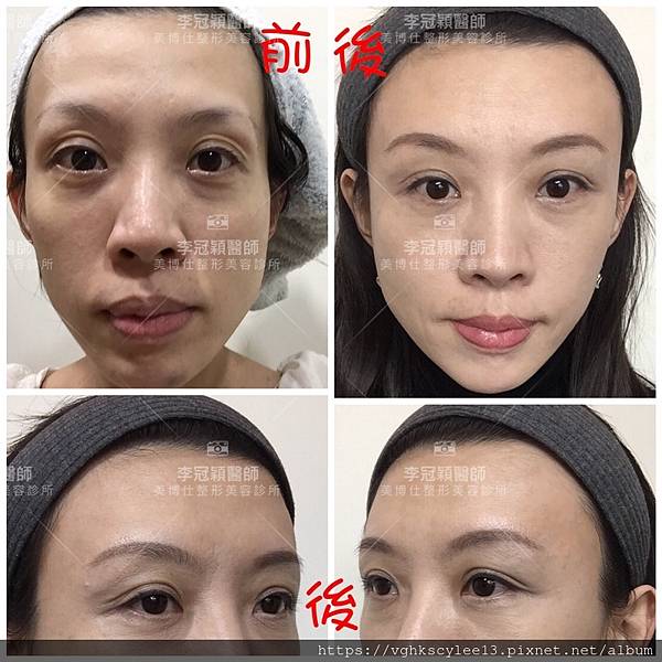 凹缺太陽穴和眉骨（眉弓）為什麼容易提早有下垂眼尾？如何治療？