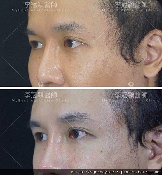 凹缺太陽穴和眉骨（眉弓）為什麼容易提早有下垂眼尾？如何治療？