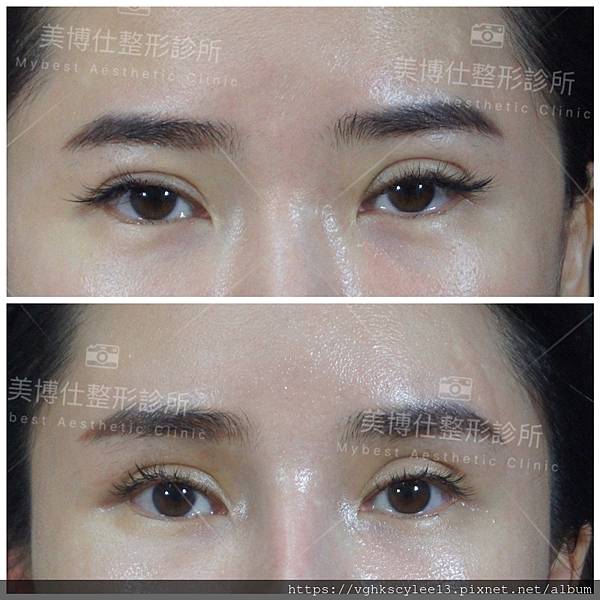 凹缺太陽穴和眉骨（眉弓）為什麼容易提早有下垂眼尾？如何治療？