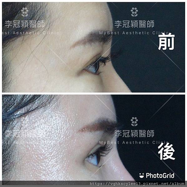 凹缺太陽穴和眉骨（眉弓）為什麼容易提早有下垂眼尾？如何治療？