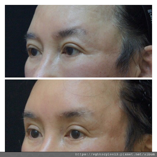 凹缺太陽穴和眉骨（眉弓）為什麼容易提早有下垂眼尾？如何治療？