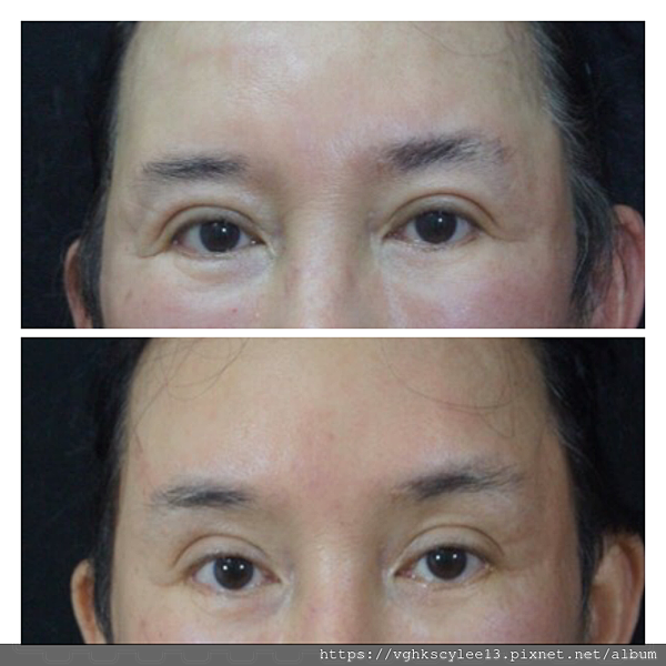 凹缺太陽穴和眉骨（眉弓）為什麼容易提早有下垂眼尾？如何治療？