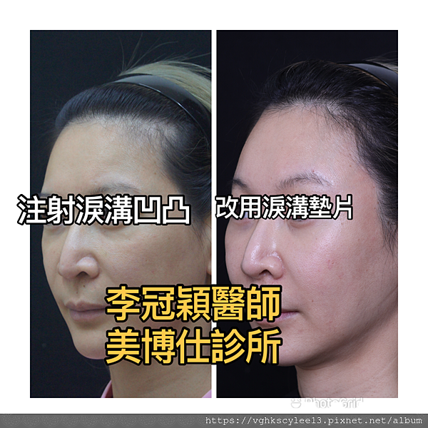 注射填充蘋果肌與墊片蘋果肌，哪個造成後續下垂？