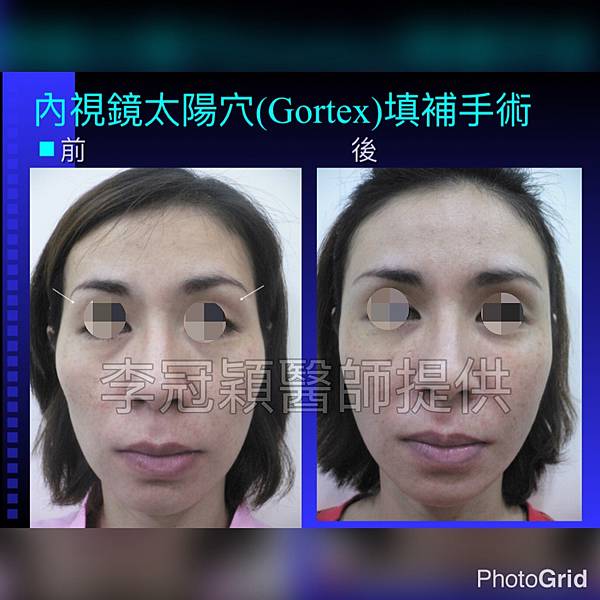 凹缺太陽穴和眉骨（眉弓）為什麼容易提早有下垂眼尾？如何治療？