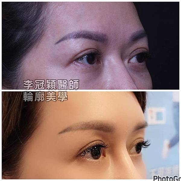 凹缺太陽穴和眉骨（眉弓）為什麼容易提早有下垂眼尾？如何治療？