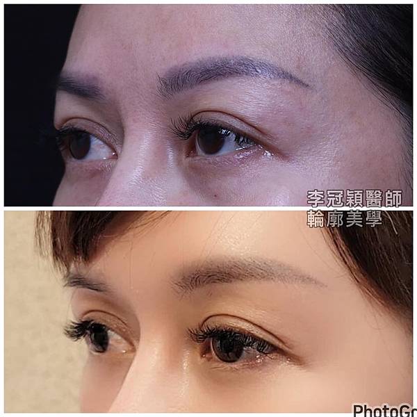凹缺太陽穴和眉骨（眉弓）為什麼容易提早有下垂眼尾？如何治療？