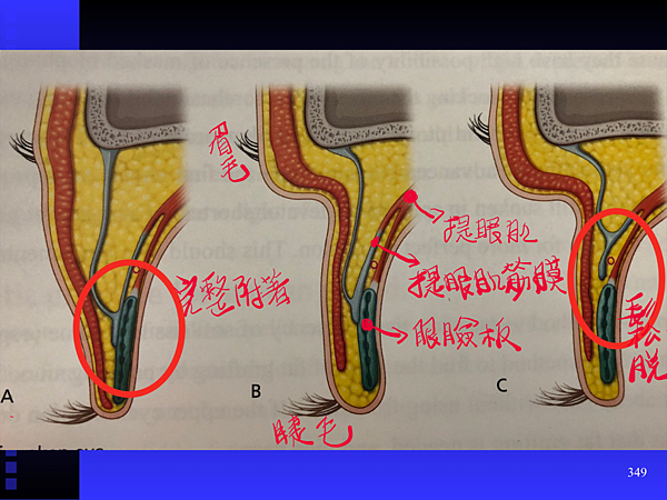 提眼肌無力矯正 提眼肌無力矯正