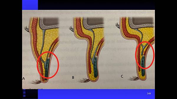 提眼肌無力矯正 提眼肌無力矯正