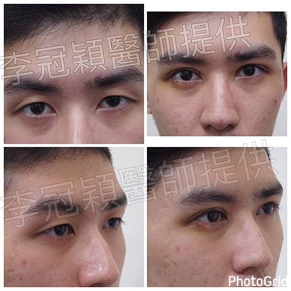 提眼肌無力矯正 提眼肌無力矯正