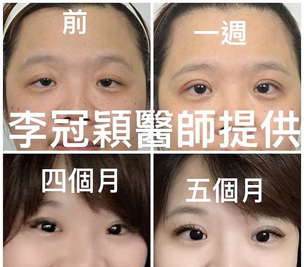 提眼肌無力矯正 提眼肌無力矯正